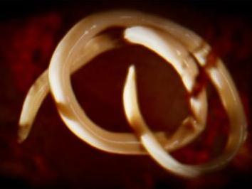 Cô gái ho ra  một tổ giun đũa