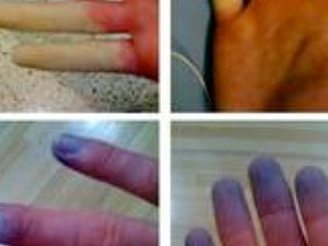 Cứ lạnh là  đau - Bệnh gì