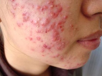 Ẩn họa từ corticoid - Vẫn còn thời sự