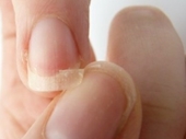 11 dấu hiệu sức khỏe mà móng tay bạn cảnh báo