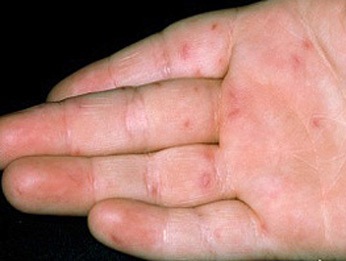 Hà Nội Xuất hiện 5 ổ dịch tay chân miệng