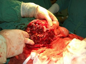 Phẫu thuật thành công cho bệnh nhân có khối u mạc treo phức tạp