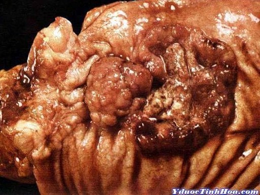 Thủ phạm khiến 6 triệu người tử vong mỗi năm