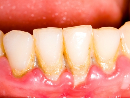 Nguy hiểm ít biết của vôi răng