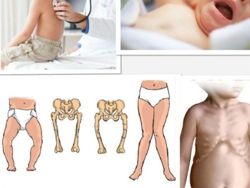 Bổ sung canxi, vitamin D sai cách Trẻ thêm còi xương