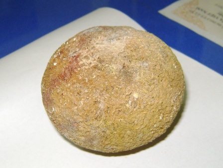 Phẫu thuật lấy viên sỏi nặng 400g trong thận