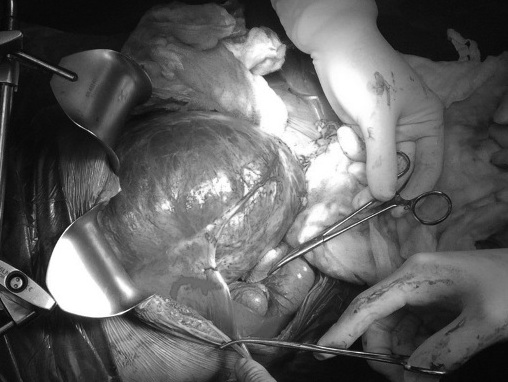 Cắt bỏ thành công khối u máu to như quả bóng cho bé 9 tuổi