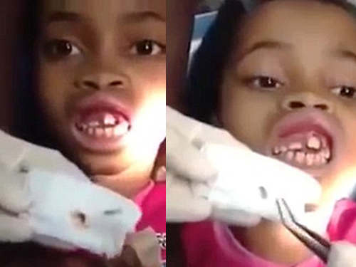 Gắp 15 con dòi ra khỏi miệng bé gái