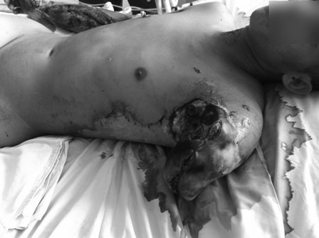 Bỏng nặng vì câu cá dưới đường điện