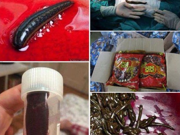 Thực hư ca phẫu thuật toàn đỉa tại BV Bạch Mai