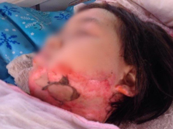 Xôn xao chuyện bé gái bị bạn đốt bỏng nửa người ở trường mầm non