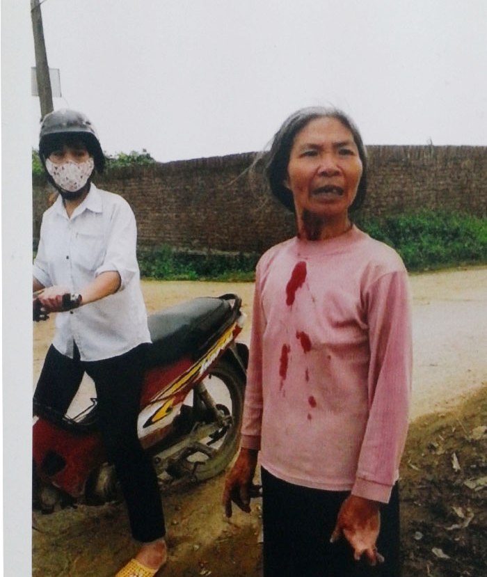 Bà Nguyễn Thị Khanh sau cuộc xô xát xảy ra vào ngày 18/03 tại xã Chỉ Đạo, huyện Văn Lâm, tỉnh Hưng Yên