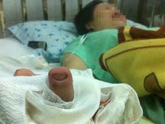 Lấy ngón chân ghép làm ngón tay