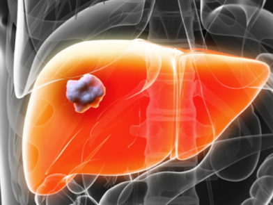 9 dấu hiệu bạn đã bị ung thư giai đoạn đầu