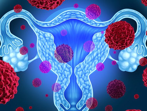 Xét nghiệm giúp phát hiện sớm ung thư buồng trứng