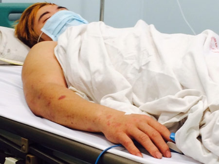 Gia tăng bệnh nhân mắc viêm não do não mô cầu