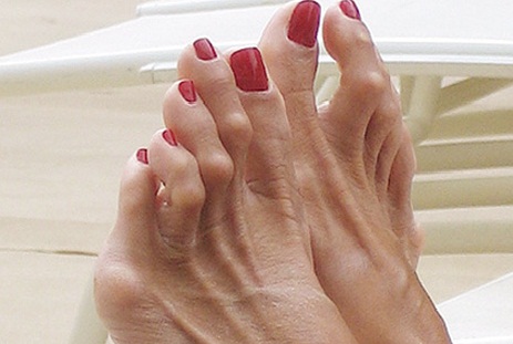 Hội chứng ngón chân búa hình thành do đi dép xỏ ngón thường xuyên