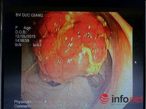 Đau bụng, đi ngoài ra máu Coi chừng polyp đường tiêu hóa