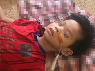 Bé 7 tuổi phải cắt bỏ 2 3 dạ dày vì uống nhầm axit