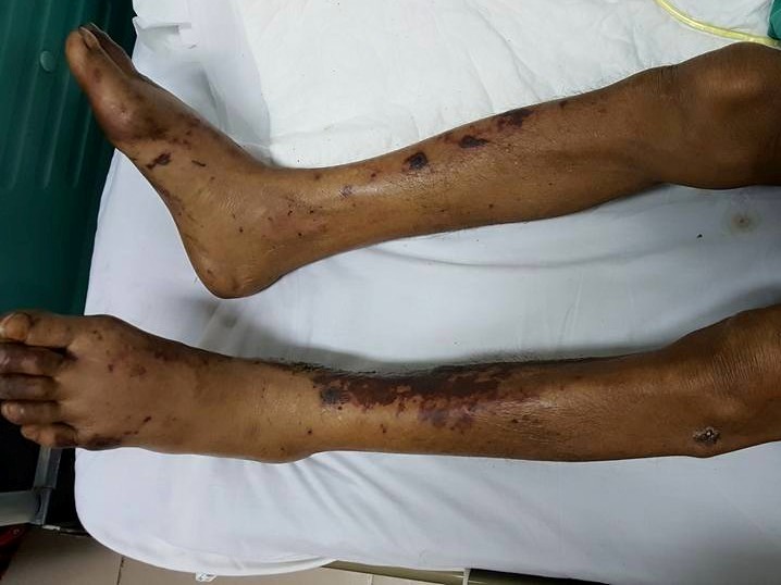 Liên tiếp 2 trường hợp tử vong vì ăn tiết canh lợn