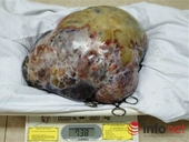 Phẫu thuật thành công bệnh nhân có khối u 7,8kg