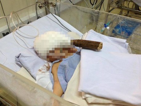 Bắt tạm giam nghi can dùng dao đâm xuyên trán trẻ sơ sinh 11 ngày tuổi