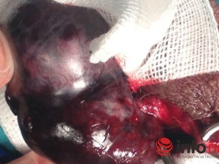 Tinh hoàn thối đen, hoại tử vì đến bệnh viện quá chậm