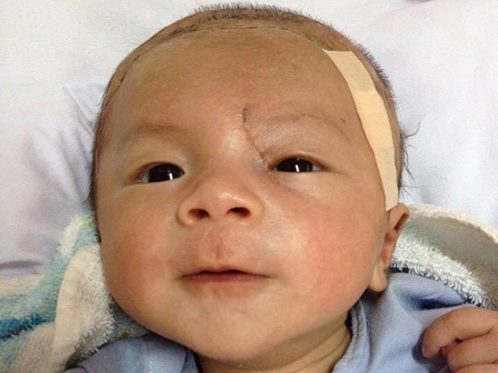 Ngày mai, bé trai bị đâm xuyên sọ xuất viện