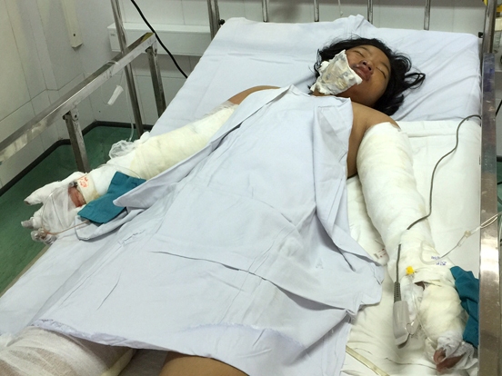 Bé gái bị mẹ đẻ tưới xăng đốt đang nhiễm trùng máu