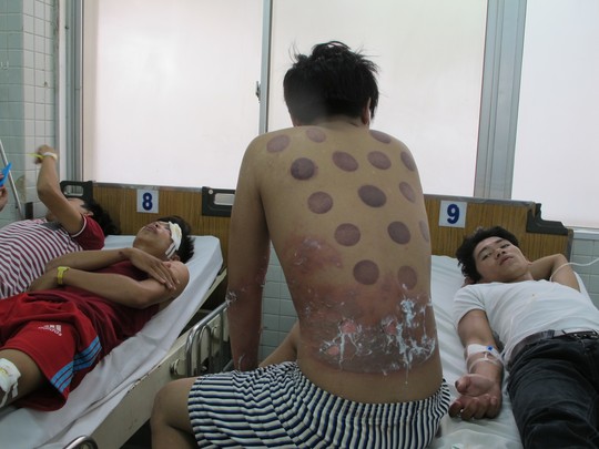 Giác hơi, mẹ vô ý đốt cháy con