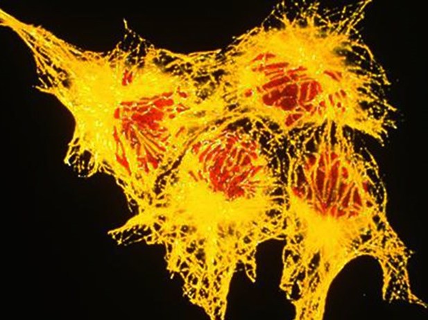 Khuyến cáo của chuyên gia về ung thư vú