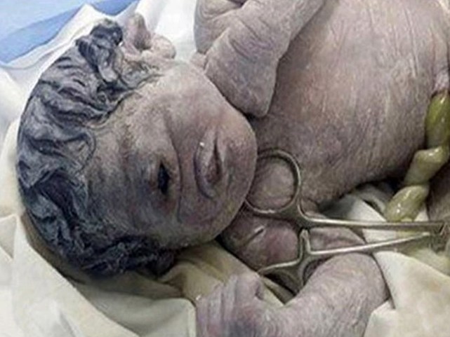 Bé sơ sinh Ai Cập chỉ có 1 mắt giữa trán