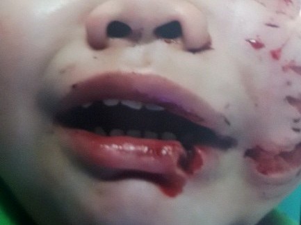 Bị chó cắn nát mặt, bé trai phải khâu 200 mũi