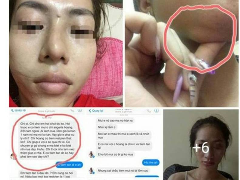 Mũi lệch, môi sưng, cằm vón cục vì bơm chất làm đầy