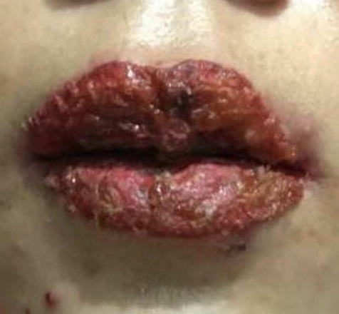 Môi chảy mủ vì nhắm mắt nghe dụ dỗ đi phun xăm