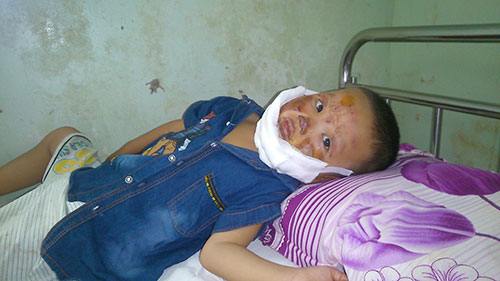 Cảnh giác và phòng ngừa tai nạn bỏng ở trẻ em