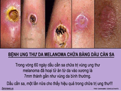 Thông tin cần sa chữa ung thư Không khỏi bệnh mà còn gây nghiện