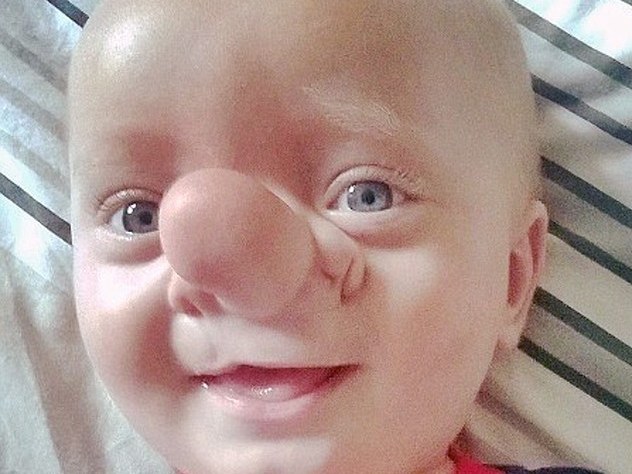 Em bé có não mọc ở mũi