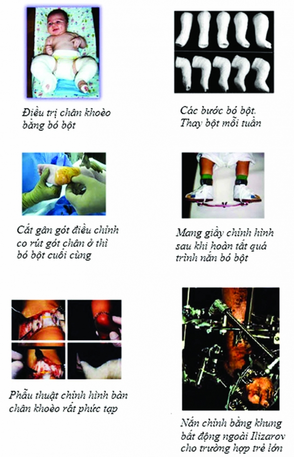 Bệnh chân khoèo ở trẻ em, chữa trị sớm, hiệu quả cao