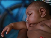 Em bé Zika , nạn nhân của virus teo não do muỗi truyền