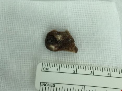 Hóc xương cá tám tháng mà không biết