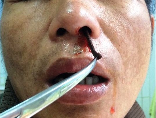 Uống nước suối bị đỉa dài 5 cm chui vào mũi