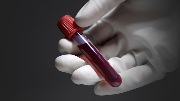  Xét nghiệm máu mới có thể phát hiện 174 gen gây bệnh tim di truyền.