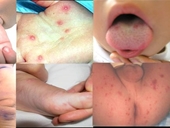 Hà Nội 73 trẻ mắc tay chân miệng, 2 ca dương tính với virus EV71