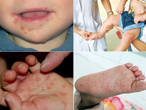 Bệnh tay chân miệng gia tăng, Bộ Y tế khuyến cáo những gì