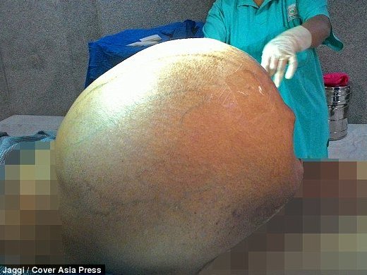 Quả phụ mang khối u nặng gần 1 tạ trong bụng