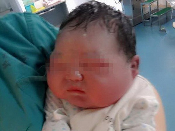 Ăn quá nhiều cháo, sản phụ sinh em bé khổng lồ nặng 6,6kg