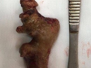 Sỏi thận dài 11 cm to như củ gừng trong cơ thể bệnh nhân Hà Nội