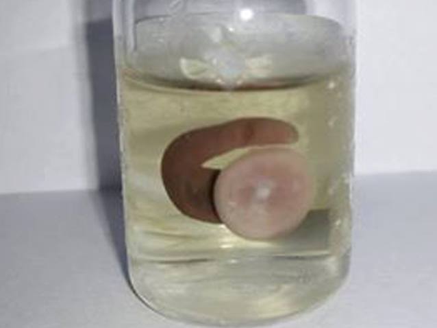 Vắt dài 3cm chui lên mũi bệnh nhân