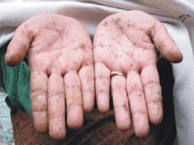 Nhiễm độc chì được coi là ngộ độc báo động ở Mỹ